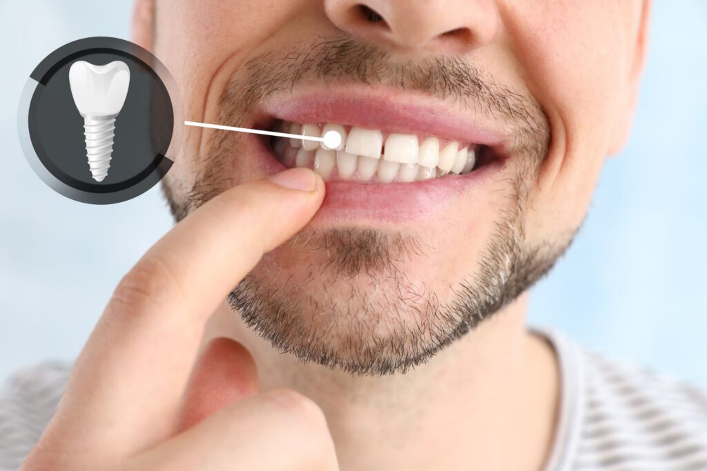 A Brighter Path to Dental Health: Exploring Dental Implants